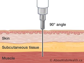 intramusclular Injection diagram